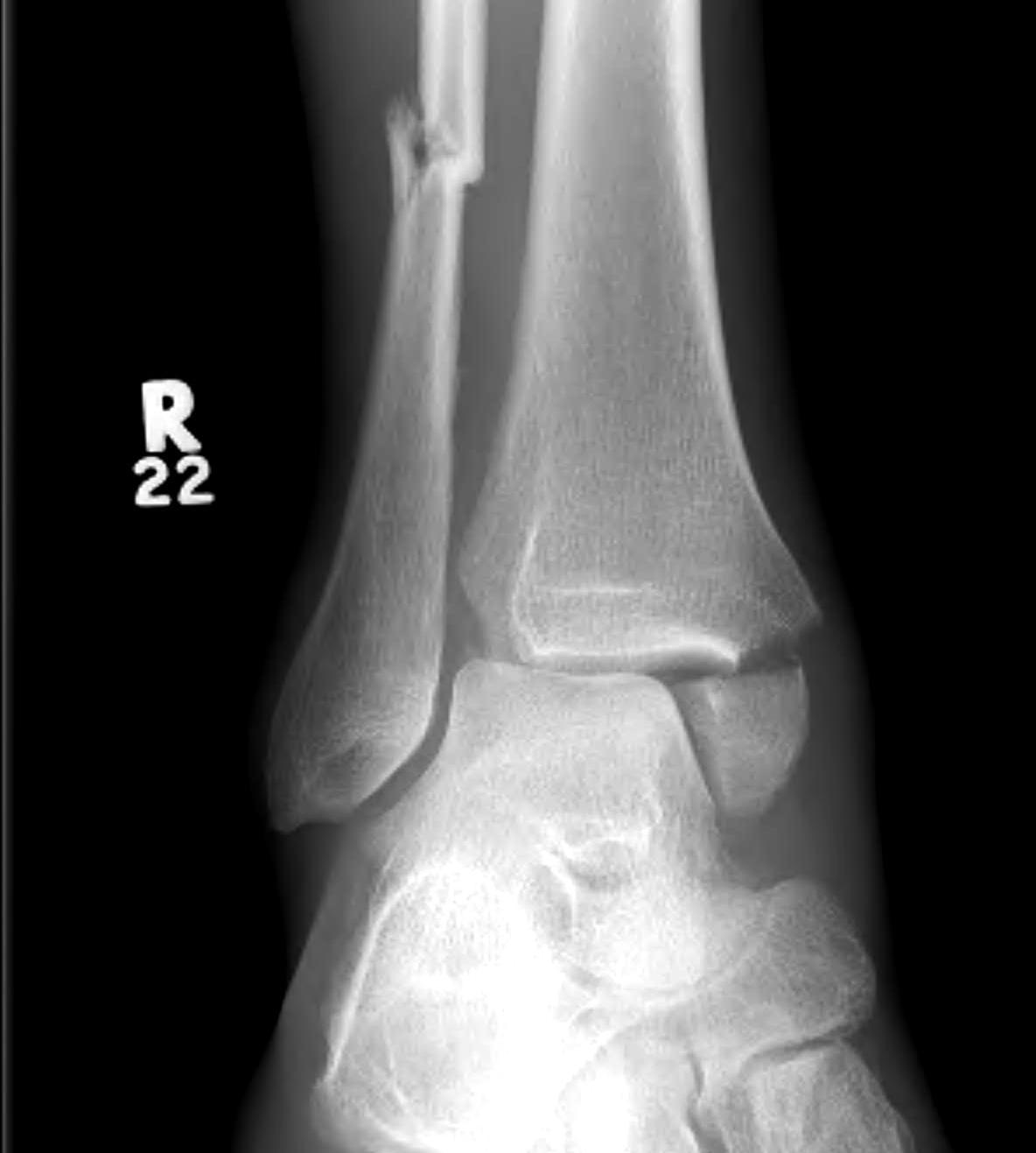 Ankle Fracture Syndesmosis Widened